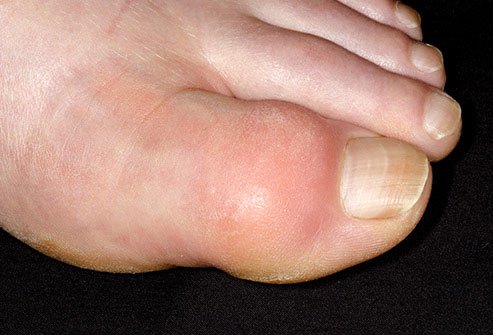 You may know that you can get this painful arthritis from eating too much red meat, organ meats, and lobster. The same goes for fructose.