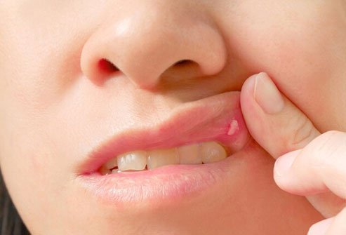 Rinsing your mouth with salt water can ease the pain and help you heal faster.