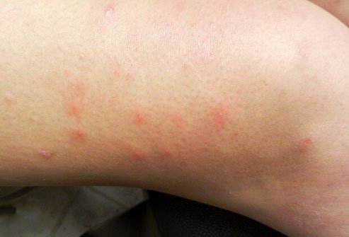 A paste made from baking soda and a little bit of water can help with any itching, stinging, or minor swelling.