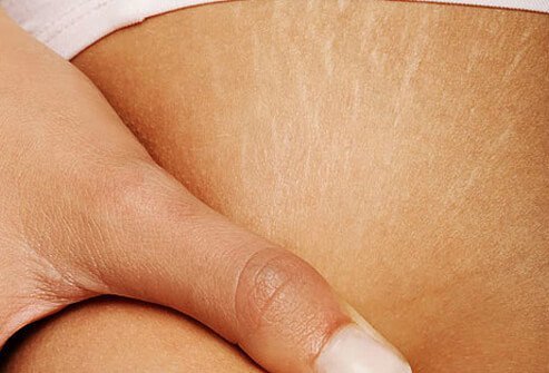 When the skin gets stretched by pregnancy, weight gain, or the normal growth of the teen years, depressed lines can develop.
