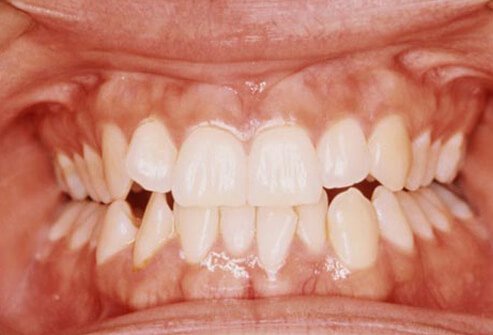 Teeth grinding, also known as bruxism, can be an inherited trait.