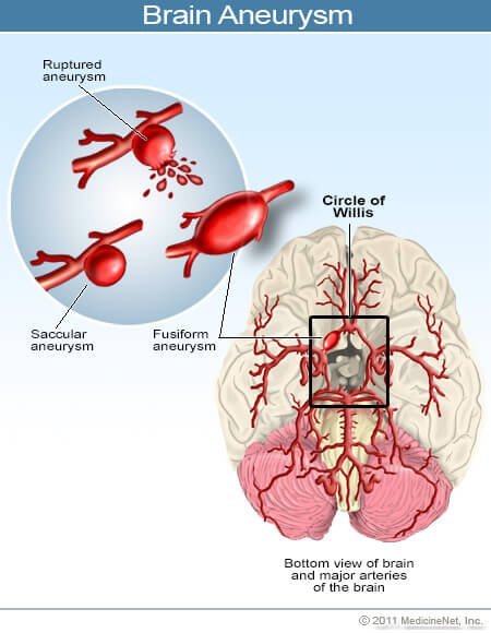 Picture of a brain aneurysm