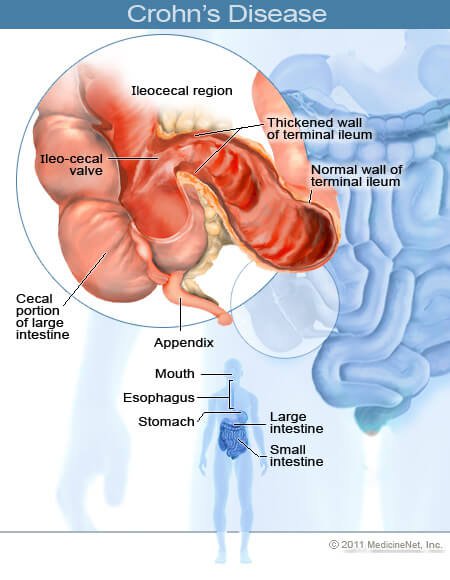 Picture of Crohn's Disease Picture of Crohn's Disease