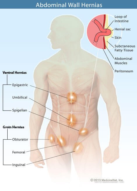Picture of different types of hernias.