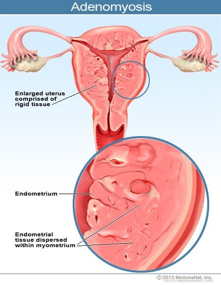 Picture of an adenomyosis