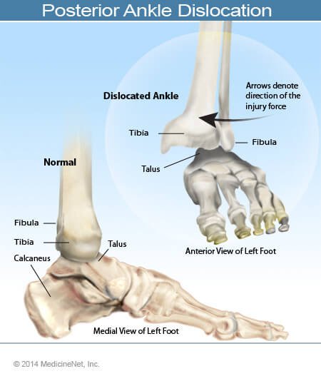 Posterior ankle dislocation