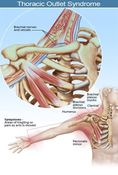 Picture of thoracic outlet syndrome (TOS) showing symptom areas Picture of thoracic outlet syndrome (TOS) showing symptom areas