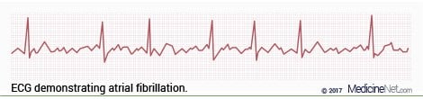 Atrial Fibrillation ECG Wave Strip Pattern