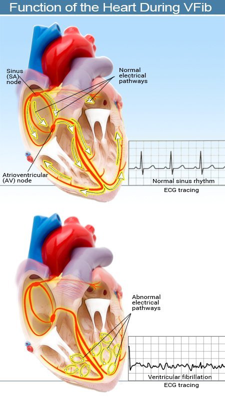 Picture of the Electrical Activity of the Heart during Ventricular Fibrillation.