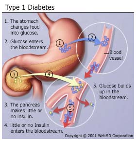 Type 1 Diabetes Type 1 Diabetes