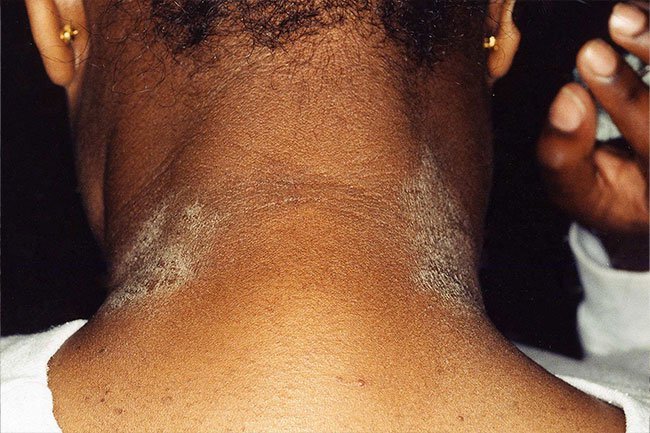 Eczema is an itchy, scaly rash that babies and children and adults can get. 