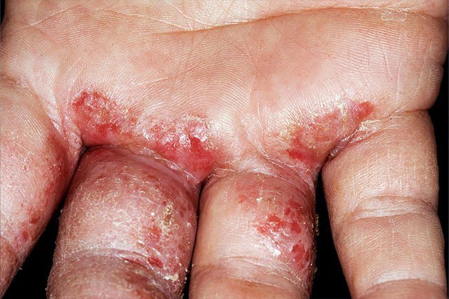 Alitretinoin may improve or clear up eczema when other treatments don't work. 