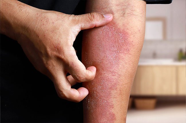 Itching and a rash are the main symptoms of eczema. 