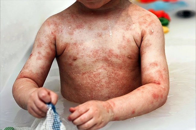 Ask your doctor if putting a small amount of bleach in your bath water may help tame inflammation. 