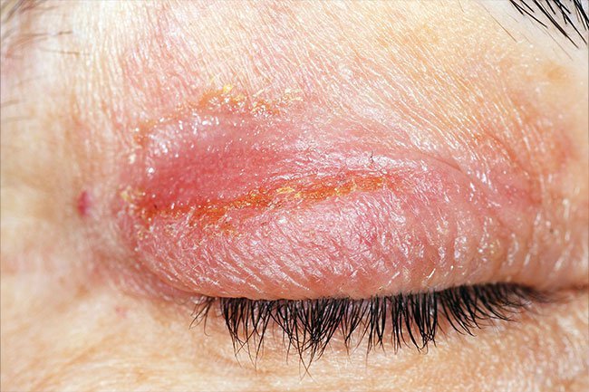 Eczema rashes may look like an infection, so ask your doctor if you are not sure what you have. 