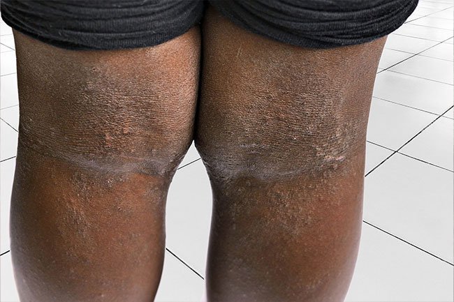 Eczema often develops on the inside of the elbows, behind the knees, and on other locations. 