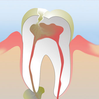 An abscessed tooth can occur when infection spreads beyond the root of a tooth.