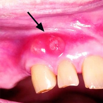 A tooth abscess can form in the gum line or jawbone.