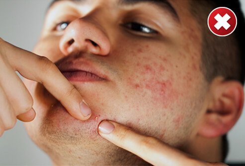 If you squeeze pimples, they take longer to heal.