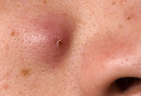 Nodules are forms of papules, but they are bigger and they form more deeply in the skin.