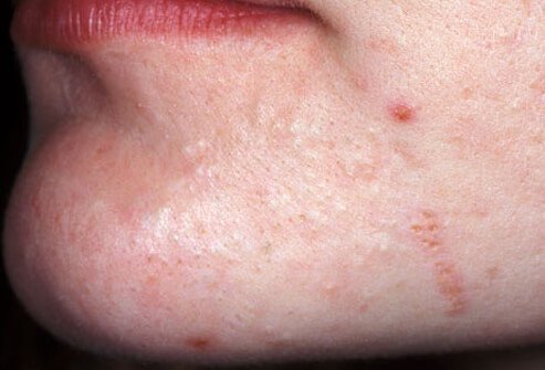 Acne may be mild.