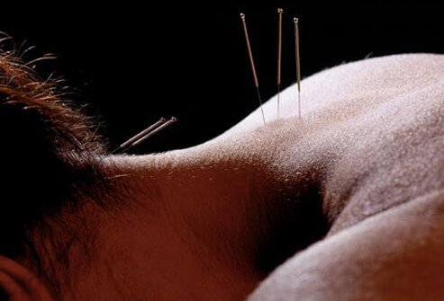 At least 20 percent of patients suffering from fibromyalgia will try acupuncture as a treatment.