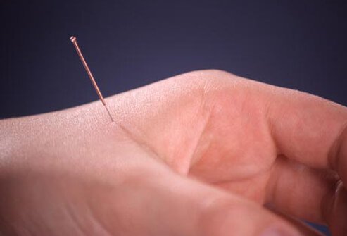 Studies suggest that acupuncture treatment can relieve pain left by dental surgery and pulled teeth.