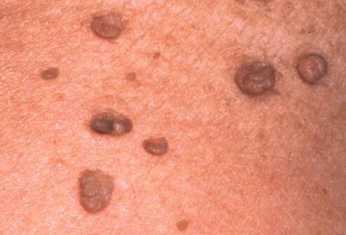 Picture of Skin Tags