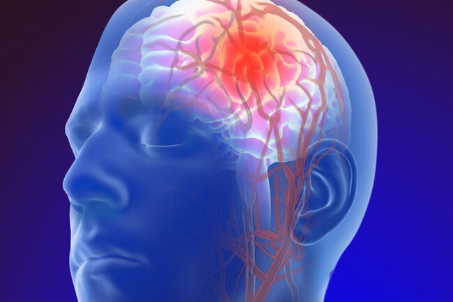 Consuming alcohol when recovering from a stroke may lead to brain problems and interactions with blood-thinners like warfarin.