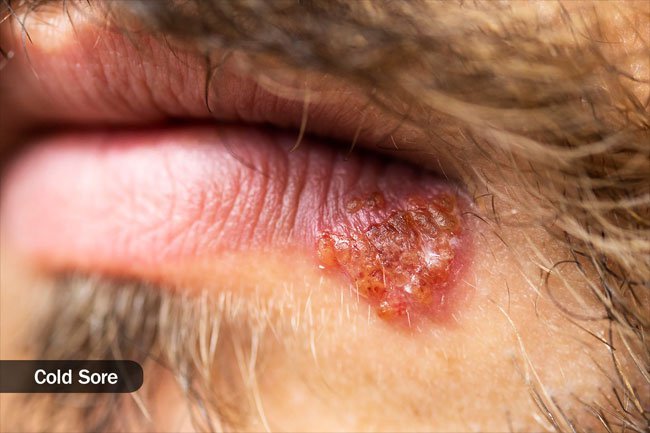 Canker sores are not the same as cold sores. 