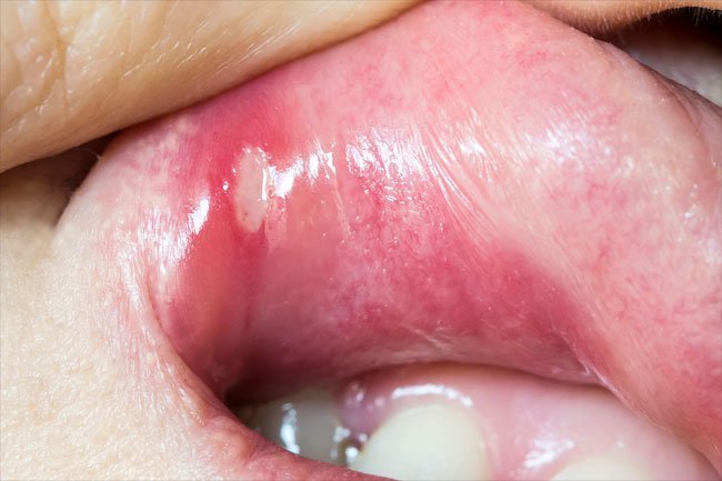 Minor canker sores are the most common type. 