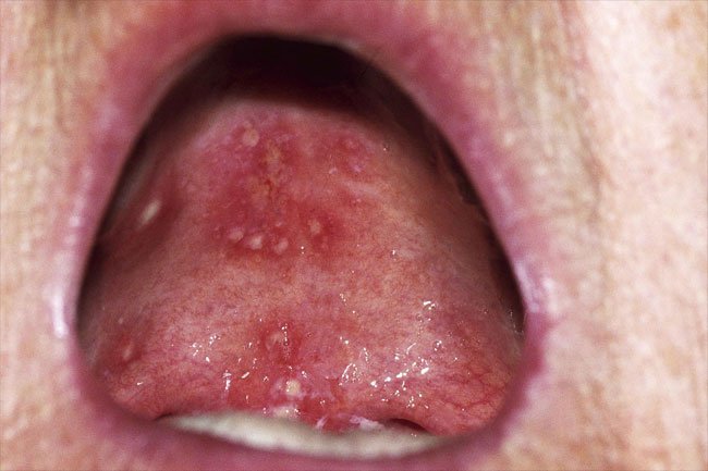 Herpetiform canker sores may be the size of a pinpoint or they may form clusters. 