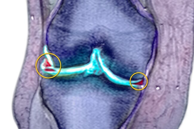 This common knee injury often happens along with others, like a torn ACL.