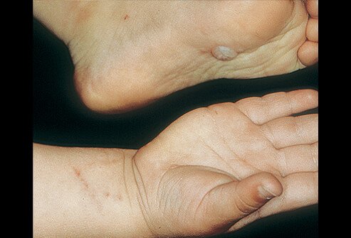 Picture of Allergic Contact Dermatitis