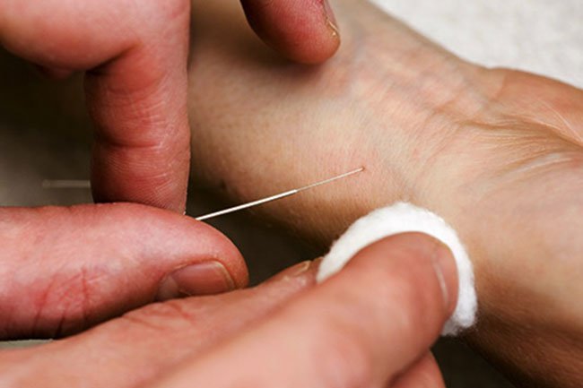 In acupuncture, targeting a point in the inner wrist could help AFib.