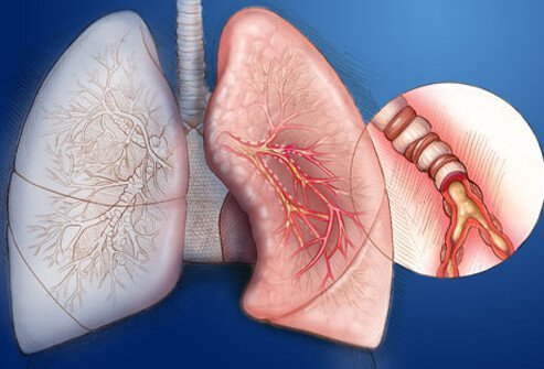 Difficulty breathing is one allergic asthma symptom.