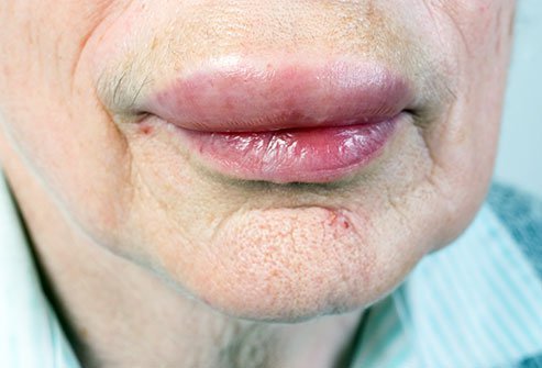 Angioedema is treated by your doctor according to the cause of your angioedema, which includes medications and home care. Angioedema is treated by your doctor according to the cause of your angioedema, which includes medications and home care.
