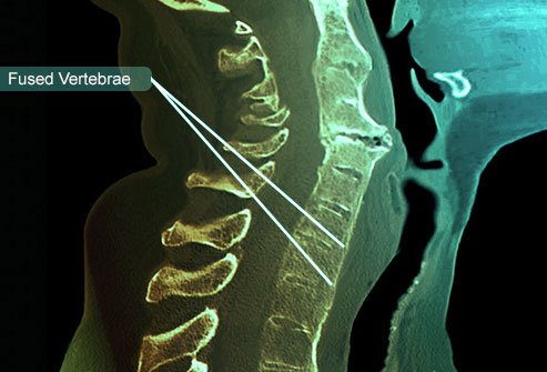 The condition affects other joints in the body in some cases including the ribs, shoulders, knees, hips, and feet.