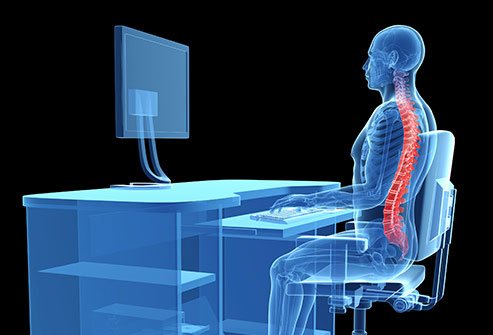 Ankylosing spondylitis can affect your posture.
