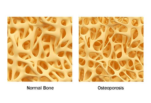 AS may degrade bone leading to osteoporosis.