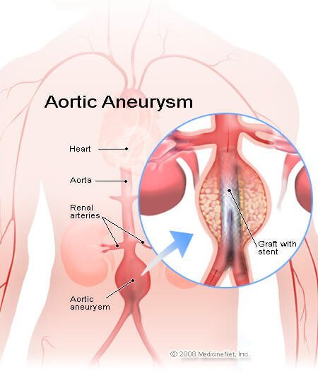 Picture of grafted stent to repair an abdominal aortic aneurysm Picture of grafted stent to repair an abdominal aortic aneurysm