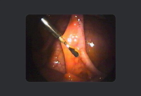 To remove the appendix, the surgeon separates it from the mesentery.