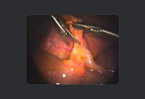 In the next step, the surgeon uses scissors to snip the appendix free from the mesentery.