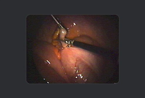 The surgeon cuts the appendix with the same scissors above the knot but below the clamp to prevent contamination.