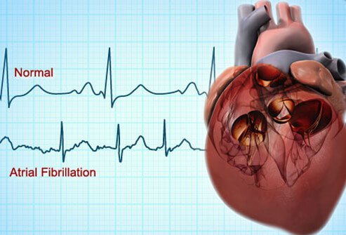 Atrial Fibrillation Atrial Fibrillation