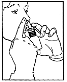 Positioning the nozzle in the nose - Illustration
