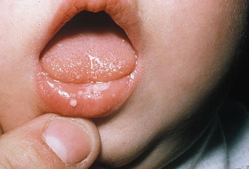 Picture of Yeast Infection (Thrush)