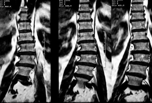 Spine abnormalities are as common in people without back pain as those who have it.