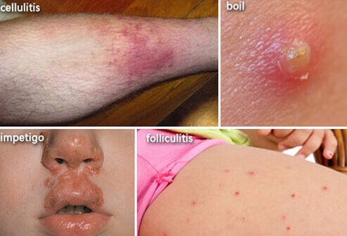 The bullous form of impetigo causes large blisters while the non-bullous form has a yellow, crusted appearance.