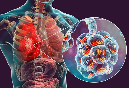 invasive pneumococcal disease
